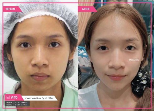 รีวิวเสริมคางแล้วเป็นก้อน-แก้ไขเป็นทรงวีมน