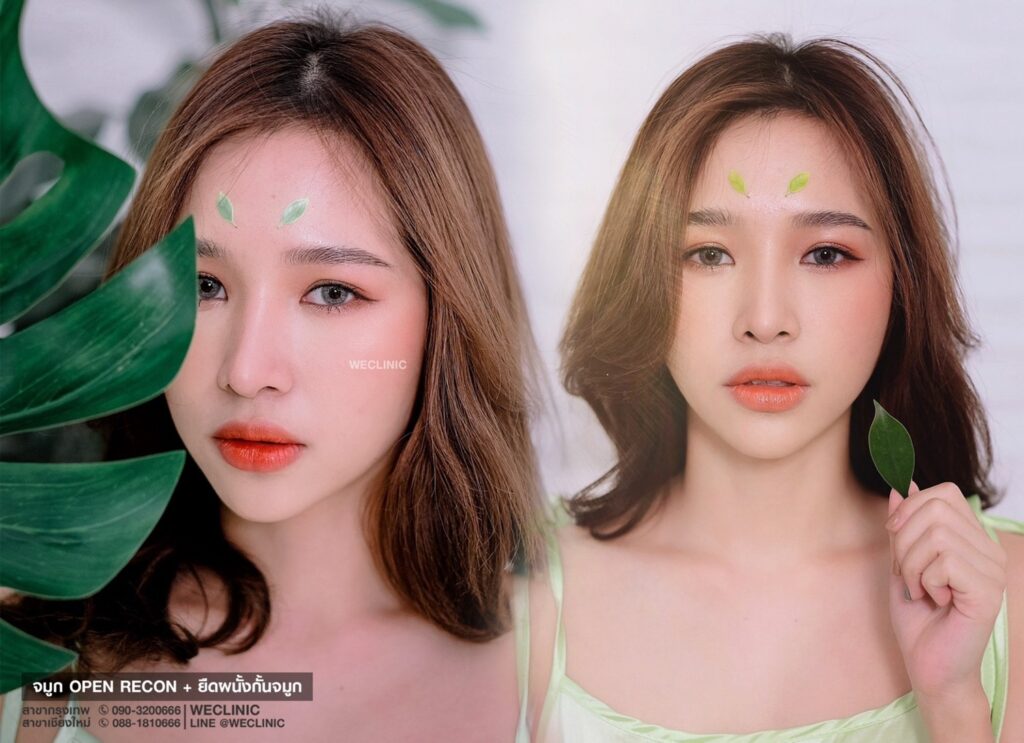 รีวิว-ทำจมูก-เนื้อจมูกน้อย-we-clinic
