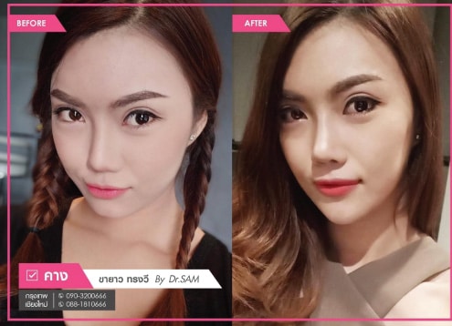 เสริมคางแล้วเป็นก้อน-แก้ไขอย่างไร