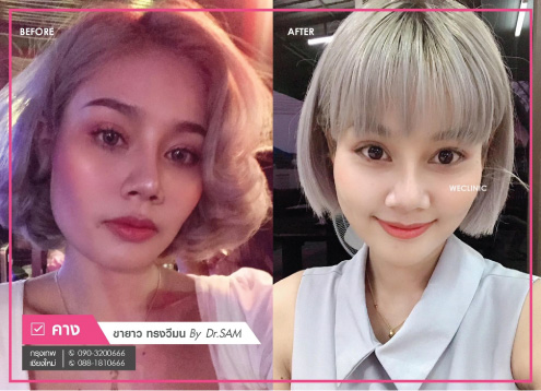 เสริมคางแล้วเป็นก้อน-แก้ไขเป็นคางขายาว-ทรงวีมน