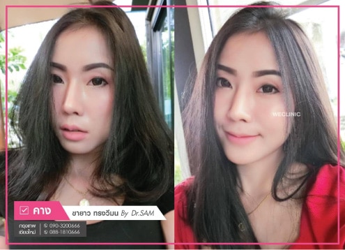 เสริมคางแล้วเป็นก้อน-ไม่สวย-แก้ไขได้