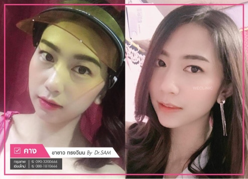 เสริมคางแล้วเป็นก้อน