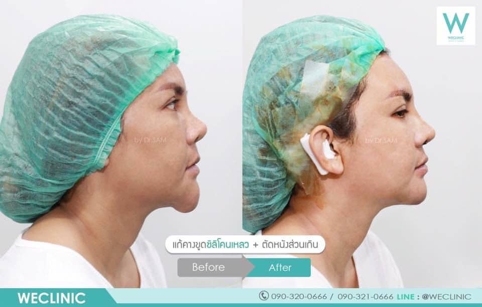 แก้คาง-ขูดซิลิโคนเหลว-ตัดหนังส่วนเกิน