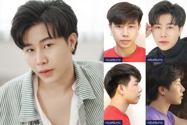 ทำคางผู้ชาย ก่อนและหลังผ่าตัด