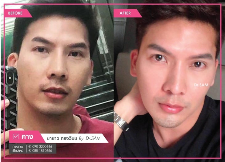 รีวิวเสริมคางผู้ชาย-ซิลิโคนขายาว-ทรงวีมน