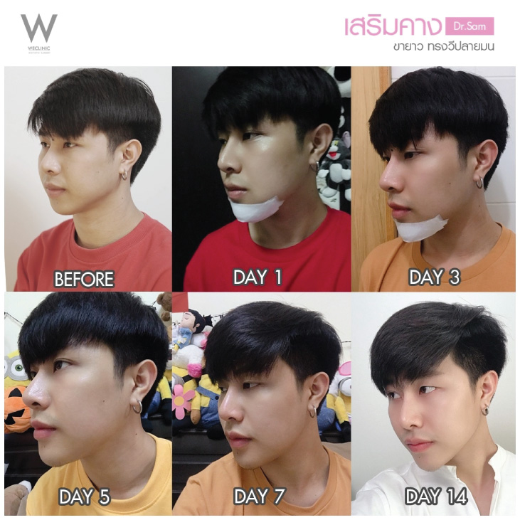 รีวิว-ก่อน-หลัง-เสริมคางผู้ชาย-ทำคางกับหมอแซม