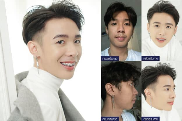 ศัลยกรรมคางผู้ชาย