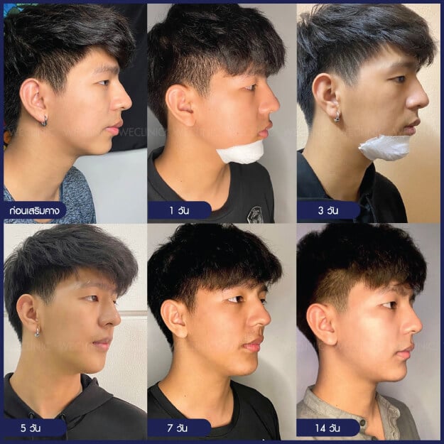 หลังเสริมคาง 14 วัน