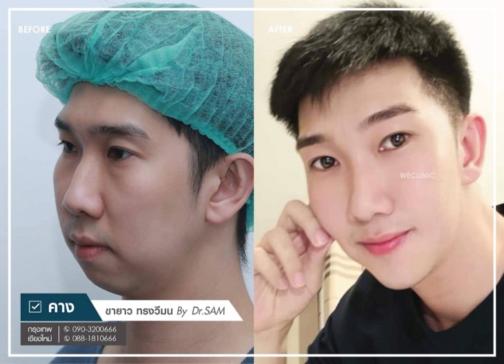 เสริมคางผู้ชาย-ขายาว-ทรงวีมน-หมอแซม