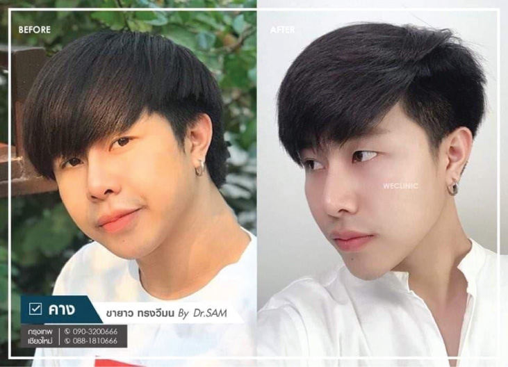 เสริมคางผู้ชาย-ทำคางผู้ชาย-ซิลิโคนขายาว-ทรงวีมน