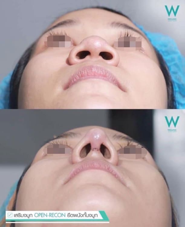 interdome-nose-จมูกเรียวสวย