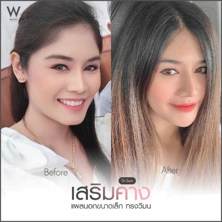 คางตัด-แก้ด้วยเสริมคาง-ทรงวีมน