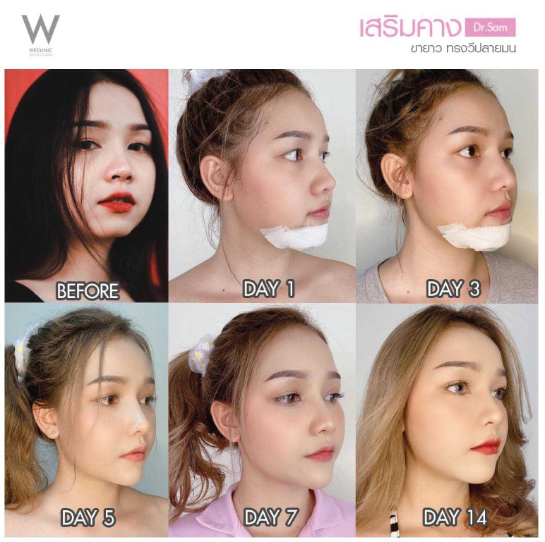 คางบุ๋ม-เสริมคาง-ซิลิโคนขายาว-ทรงวีมน