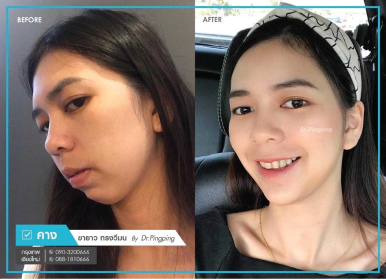 คางสั้น-คางถอย-เสริมคาง-ปรับรูปหน้า