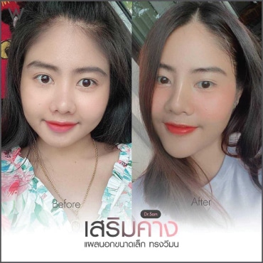 คางสั้น-หน้ากลม-เสริมคางปรับรูปหน้า