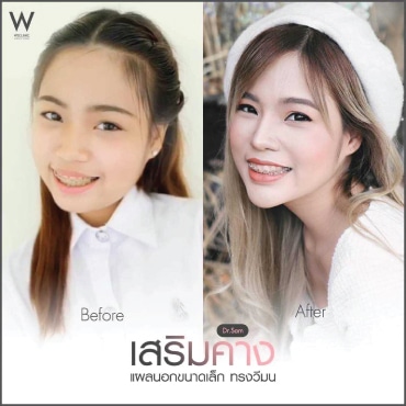 คางสั้น-หน้ากลม-แก้ไขด้วยการเสริมคาง