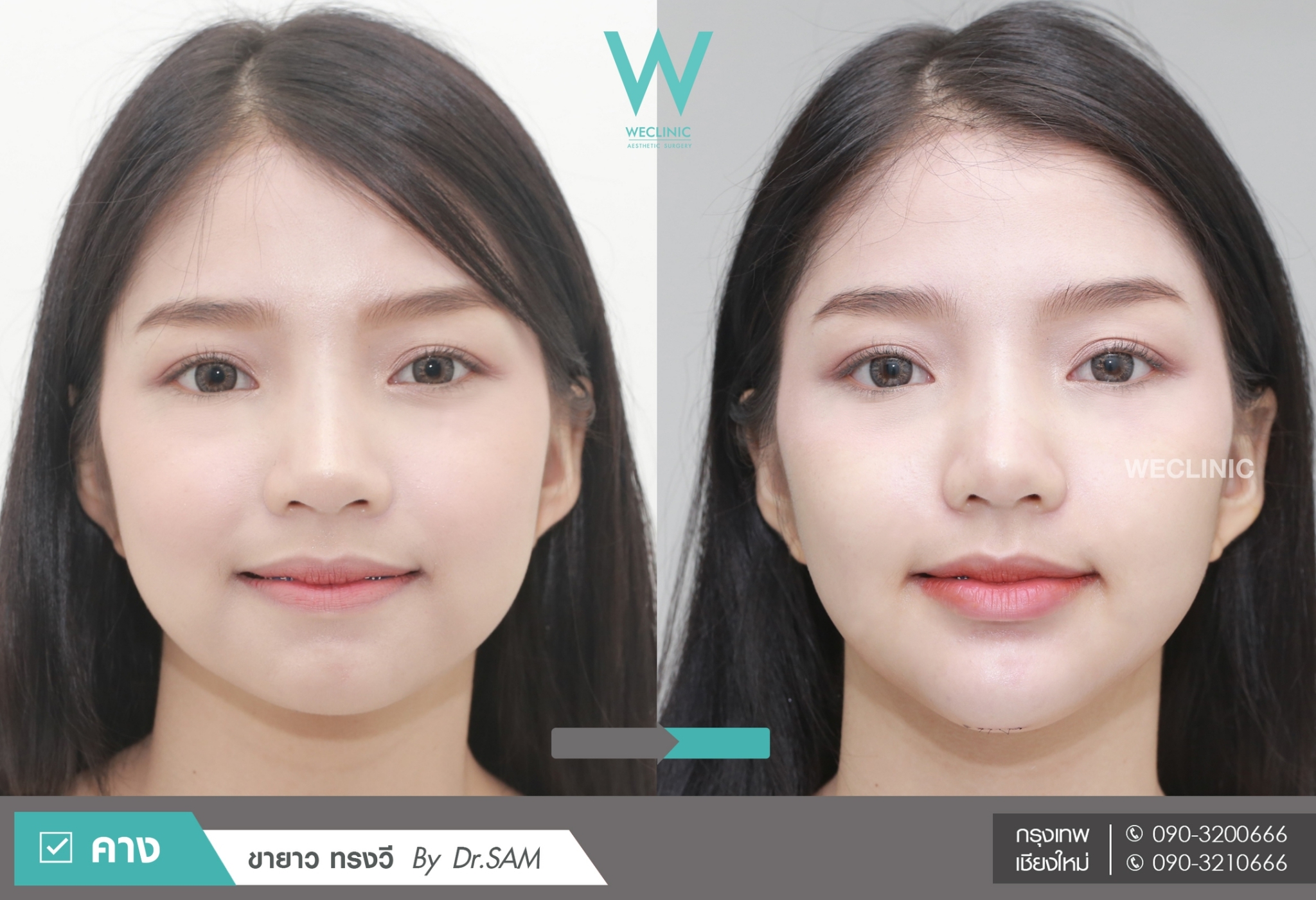 ก่อนทำคาง หลังทำคาง เสริมคางซิลิโคนขายาว หมอแซม we-clinic