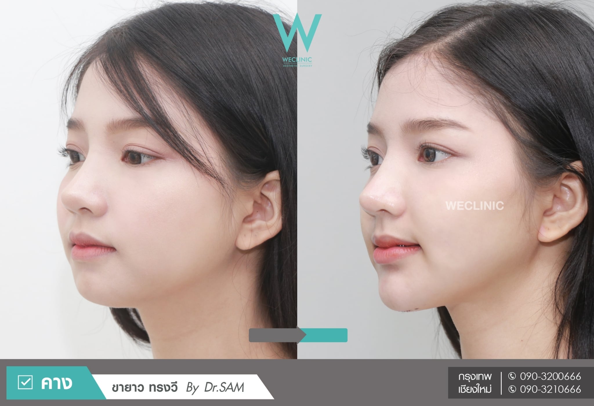 รีวิวทำคาง ก่อน-หลังเสริมคางซิลิโคนขายาว