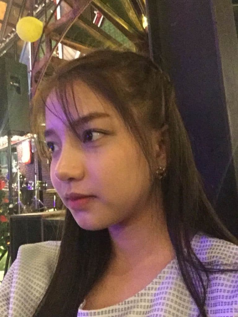 เสริมคาง รีวิว ก่อนศัลยกรรมผ่าตัดคาง