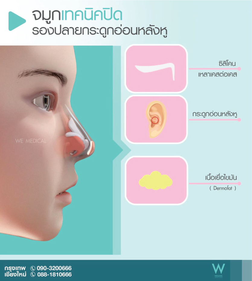 เสริมจมูกกระดูกอ่อนหลังหู