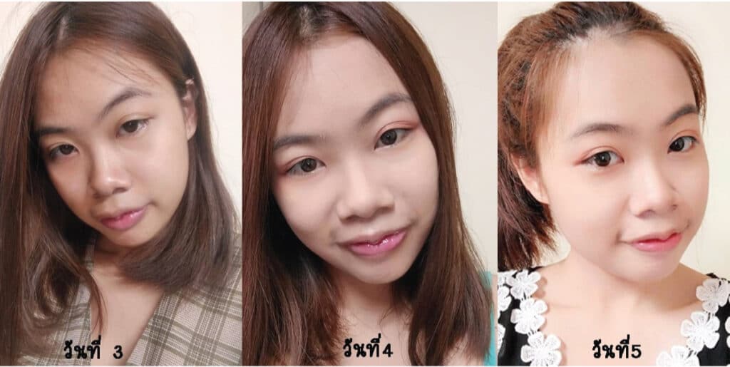 รีวิวปากกระจับ-หลังทำ-3-วัน-4-วัน-5-วัน