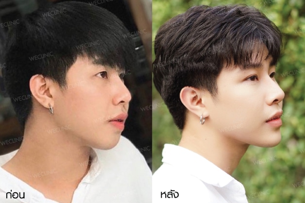 รีวิวทำคางผู้ชาย