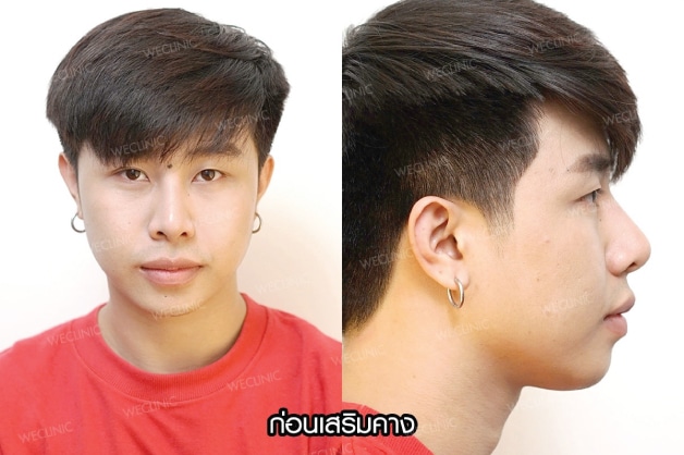 รีวิวศัลยกรรมคาง