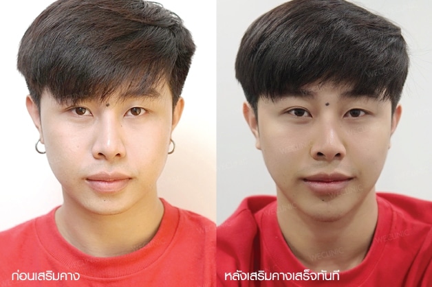 รีวิวหลังทำคางผู้ชาย