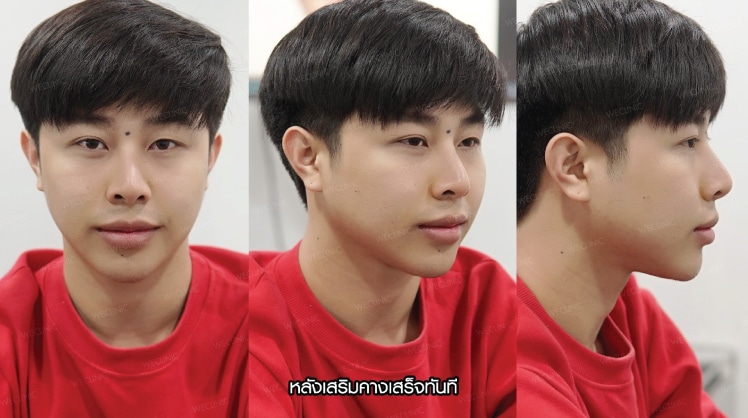 รีวิวหลังเสริมคางผู้ชาย