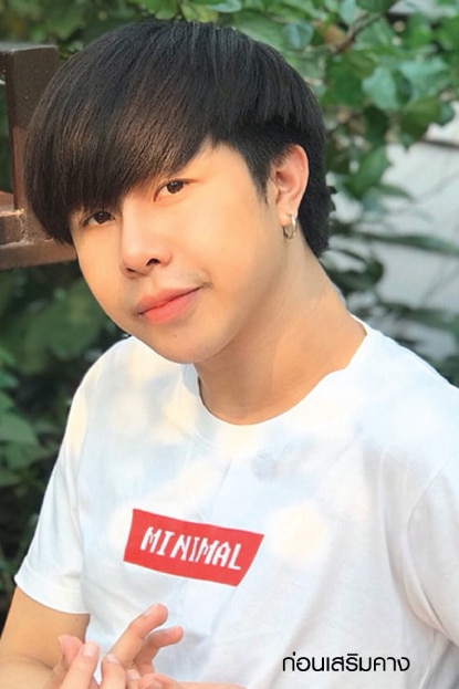 เสริมคางผู้ชาย