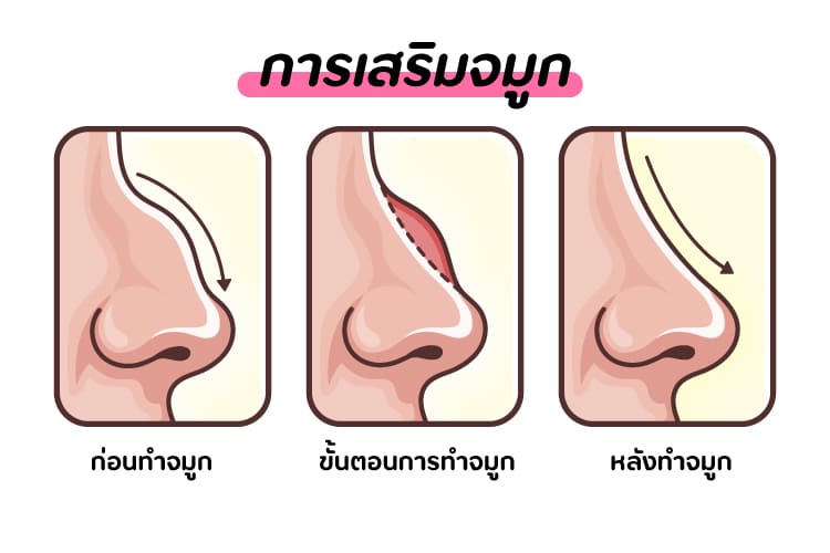 ขั้นตอนการเสริมจมูก