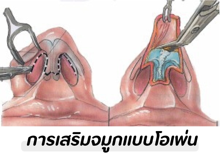 ความยาก-ง่าย และเทคนิคพิเศษที่ใช้ในการทำจมูก