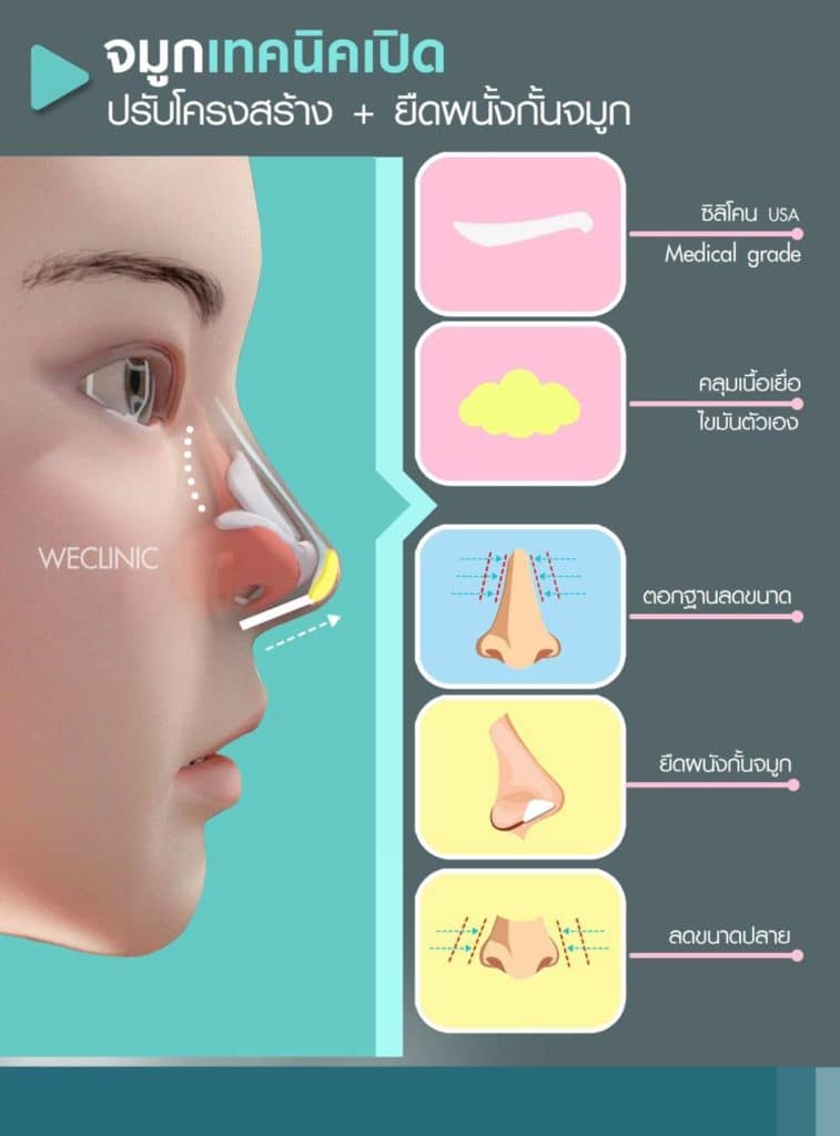 ทำจมูกเทคนิคโอเพ่น