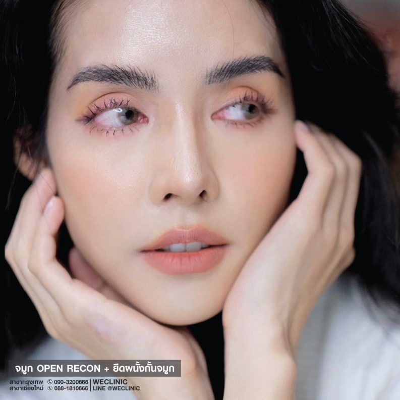 รีวิวเสริมจมูกแบบโอเพ่น