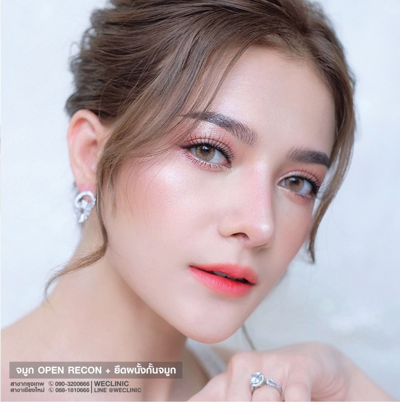 การเสริมจมูกแบบเปิด ทรงจมูกหยดน้ำ