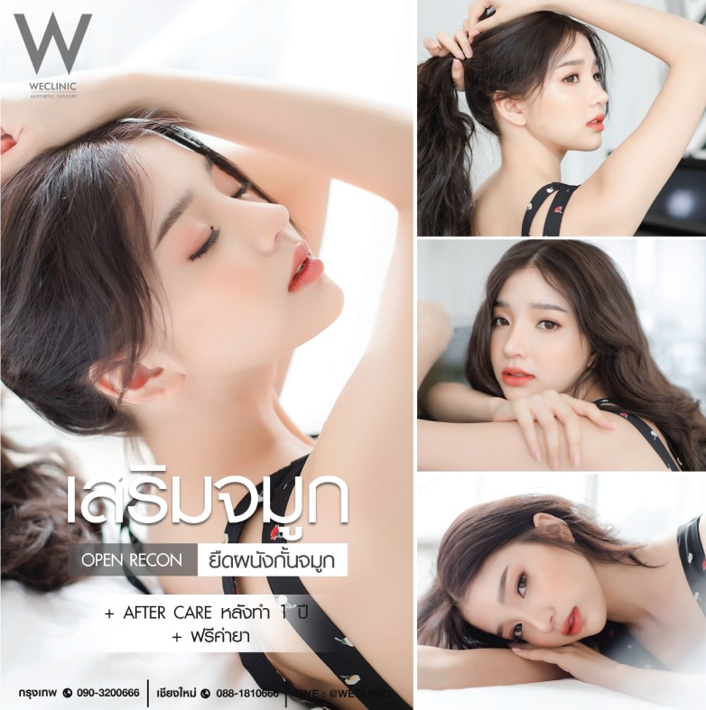 จมูกทรงหยดน้ำ หลังทำจมูกเทคนิคโอเพ่น