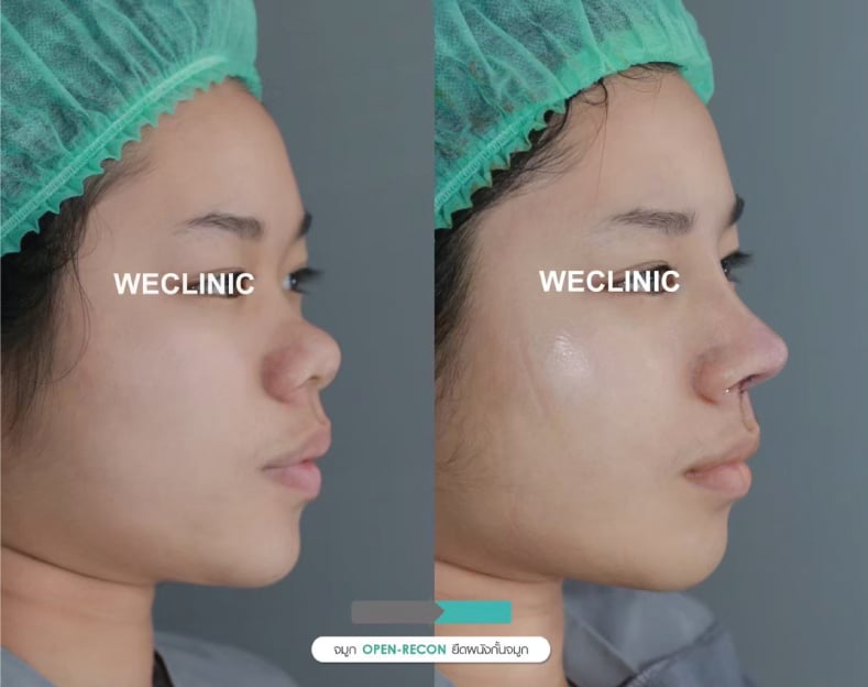 จมูกบาน คืออะไร