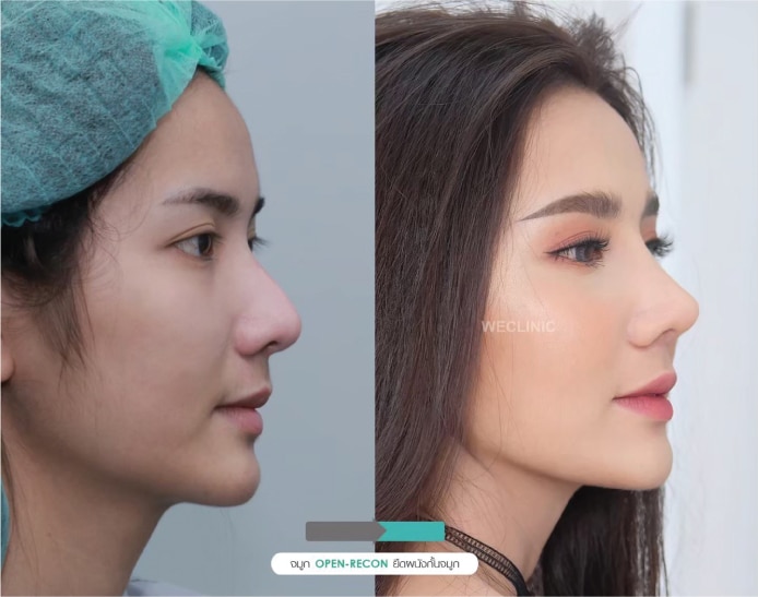 รีวิวก่อนและหลังทำจมูก