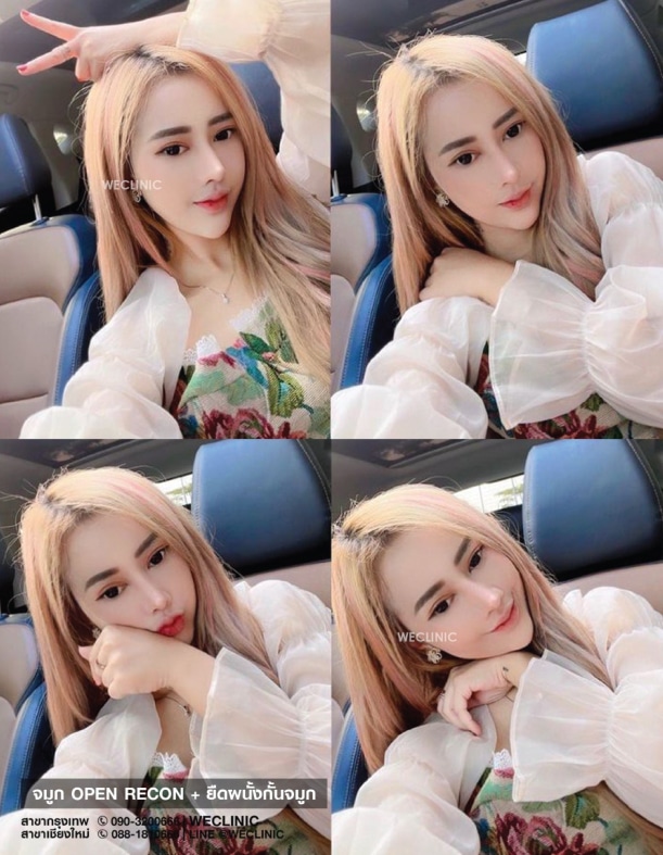 รีวิวจมูกทรงหยดน้ำ