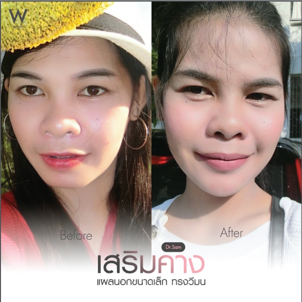 รีวิวทำคาง ทรงวีมน