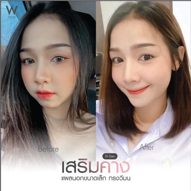 รีวิวทำคาง