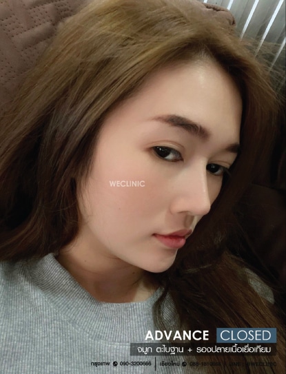 รีวิวทำจมูกแบบปิด