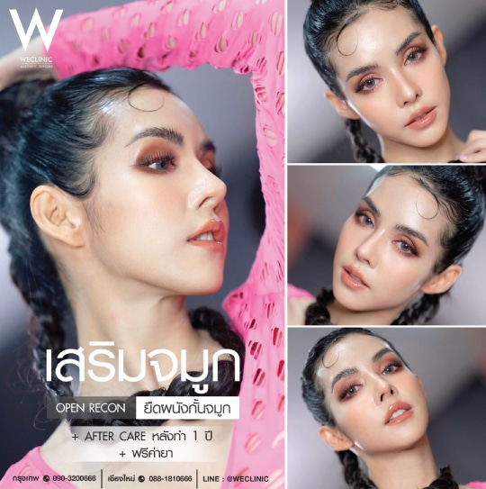 รีวิวทำจมูก โด่งพุ่ง เป็นธรรมชาติ