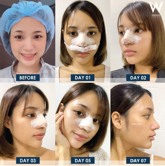 รีวิวหลังเสริมจมูกใน 7 วัน