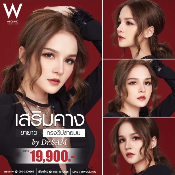 รีวิวเสริมคางขายาว สายฝอ หวาน