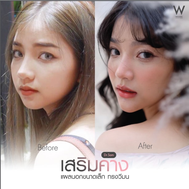 รีวิวเสริมคางขายาว