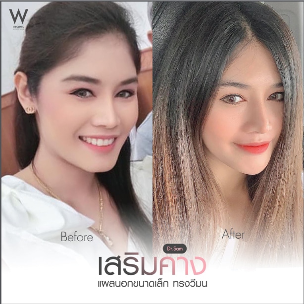 รีวิวเสริมคางหน้ากลม