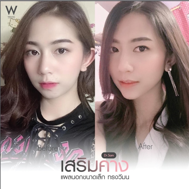 รีวิวเสริมคางแผลนอก