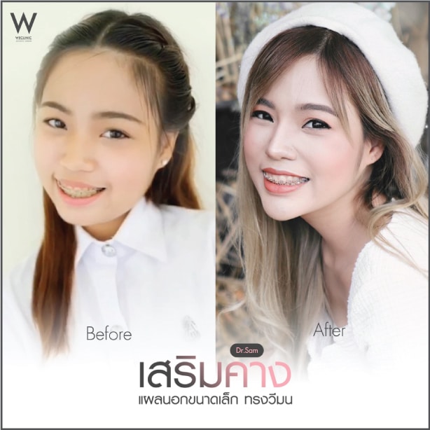 รีวิวเสริมคางแผลเล็ก