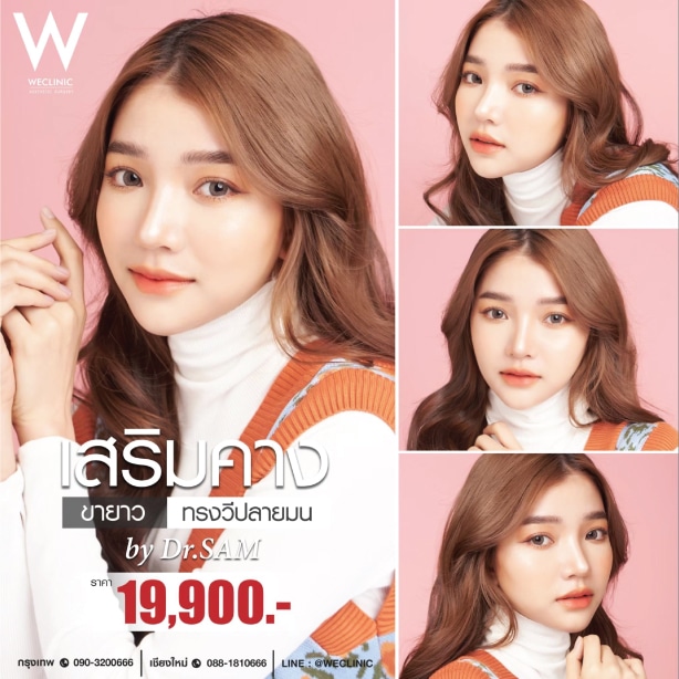 รีวิวเสริมคาง ขายาว ทรงวีปลายมน